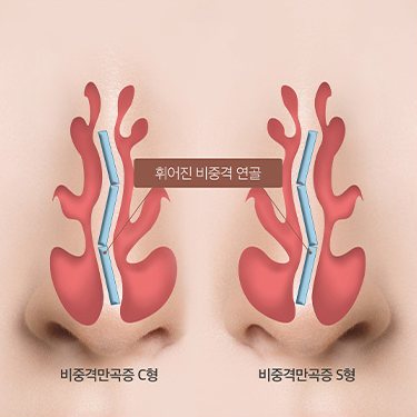 비중격 만곡증 도식