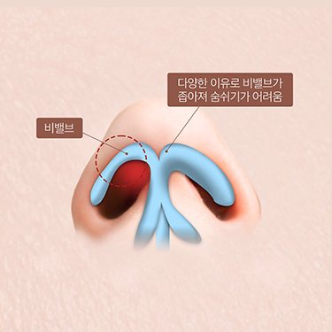 비밸브 협착증 도식