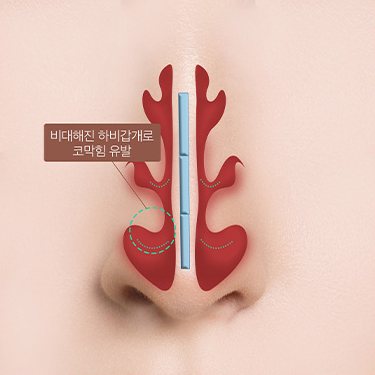 하비갑개 비대증 도식 — 비대해진 하비갑개로 코막힘 유발