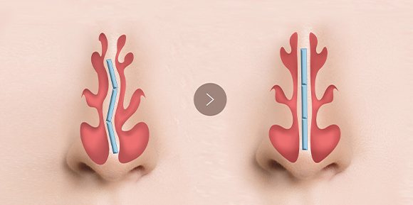 비중격 만곡증 교정 전(휘어진 비중격)과 교정 후(반듯해진 비중격) 도식