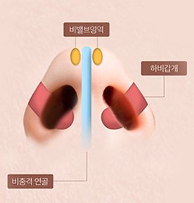 비밸브 협착증 도식 — 비밸브영역·하비갑개·비중격 연골