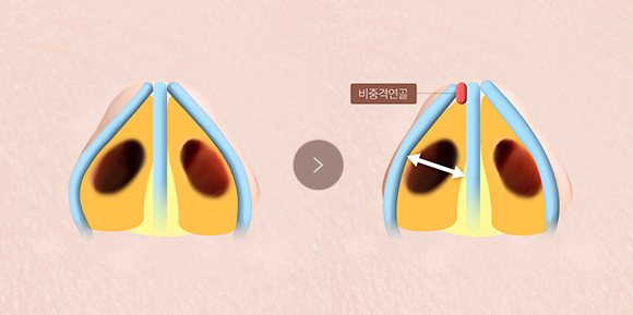 확장펼침이식 교정 전·후 도식 — 비중격연골로 비밸브 각도를 넓힘