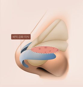 비익강화이식 도식 — 외측벽 연골 이식